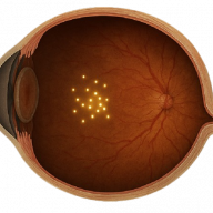 Bascom Palmer Eye Institute realiza la primera cirugía en Florida tras la aprobación de la FDA para tratar una enfermedad retiniana rara